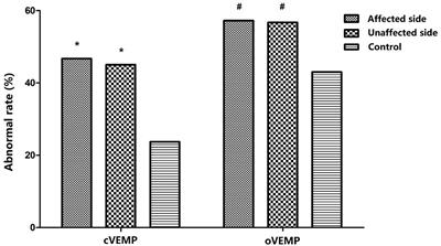 Bilateral Dysfunction of Otolith Pathway in Patients With Unilateral Idiopathic BPPV Detected by ACS-VEMPs